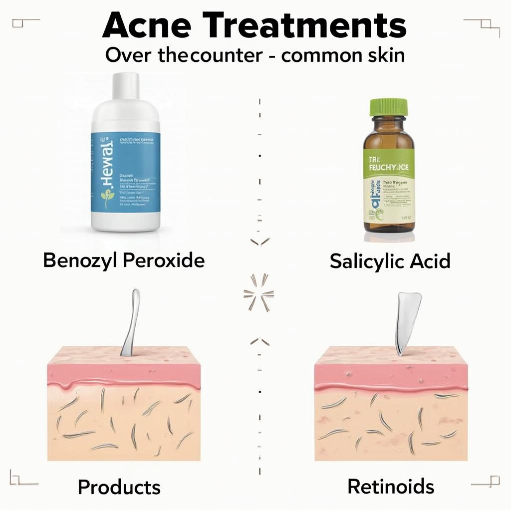 Common Acne Treatments