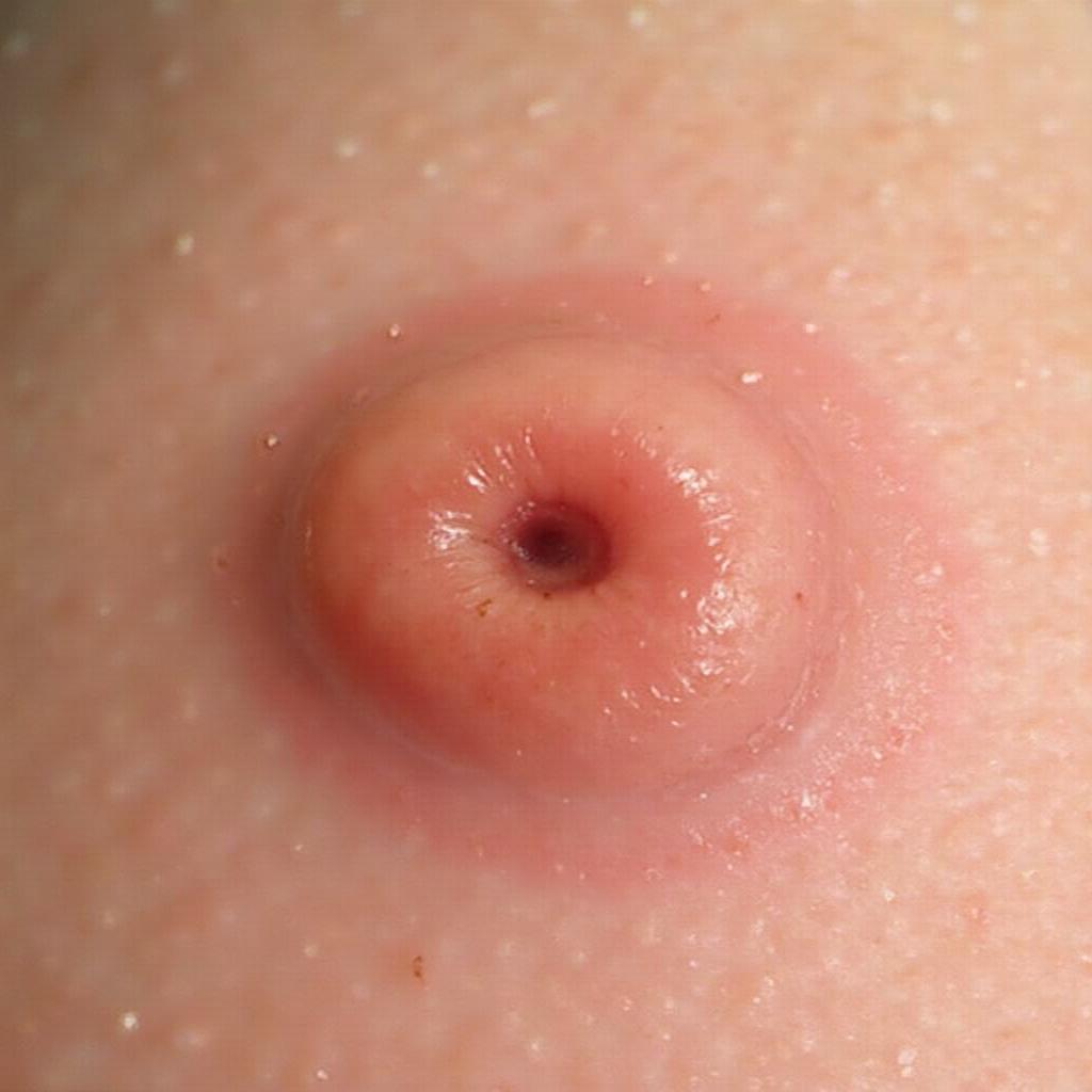 Epidermoid Cyst Appearance